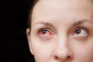 Woman's eye affected by conjunctivitis
