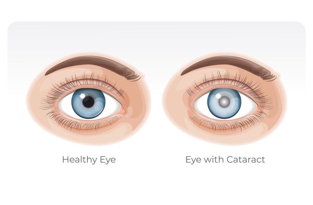 Drawing of a healthy clear eye next to a cloudy eye with cataracts