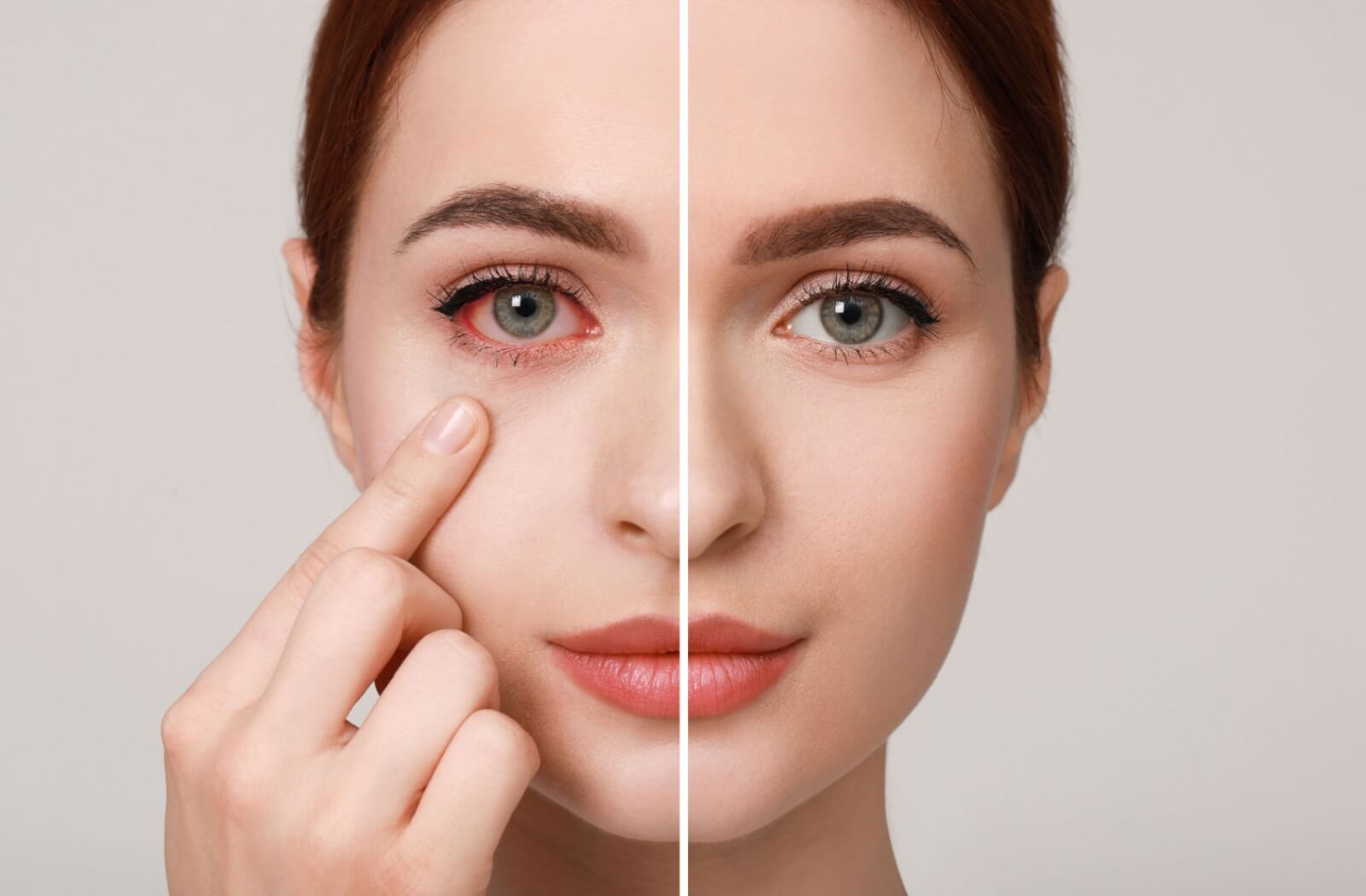 Side-by-side image of an irritated red eye and a clear healthy eye, highlighting symptoms of pink eye and effective treatment