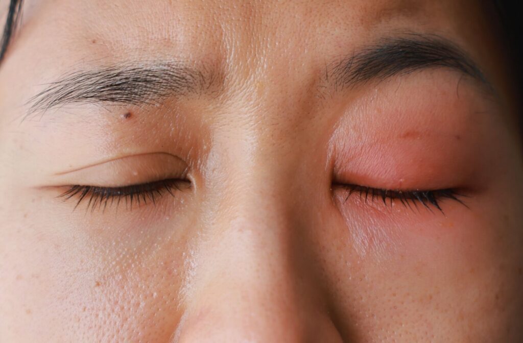 An extreme close-up of a person’s closed eyes, showing significant redness, inflammation, and swelling on the left eyelid due to an allergic reaction.